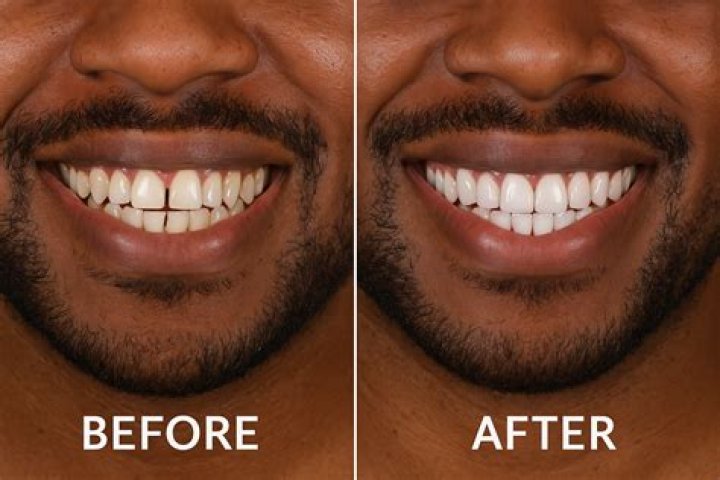 Glimpse Of Anthony Davis Before And After Teeth