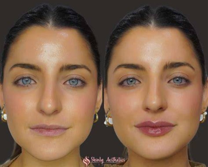 Has Aubrey Plaza Done Plastic Surgery? Fans Curious About Lip Filler And Nose Job