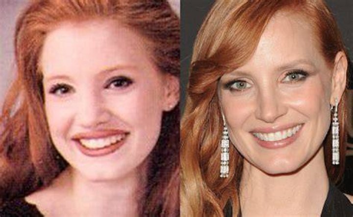 
Jessica Chastain | Nose Surgery 