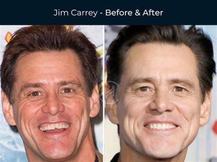 Toni Collette Teeth Before And After | What Is Wrong With Her Face