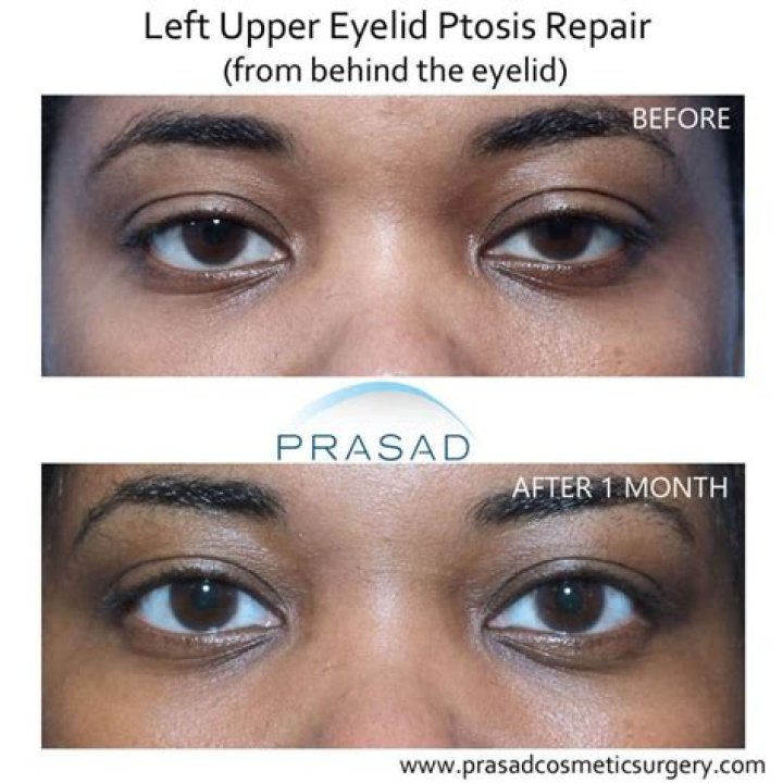 
What Happened To Forest Whitaker Left Eye, Does He Have Ptosis – Lazy Eye? 