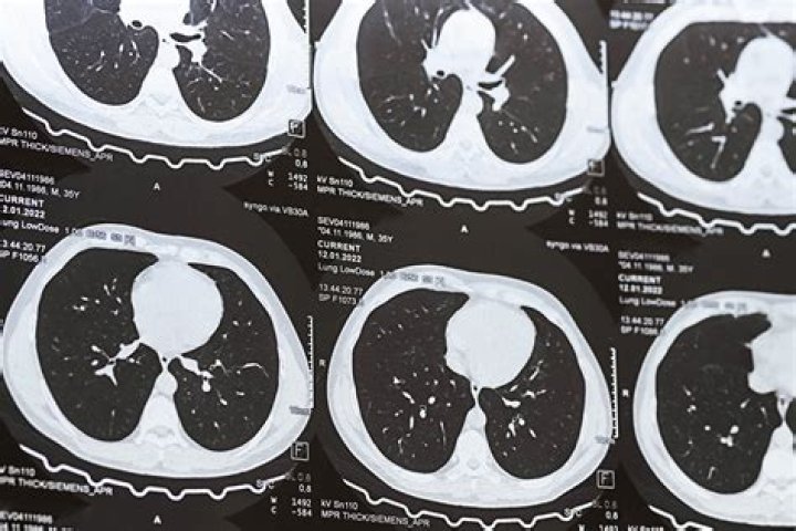 
What is a lung nodule? Symptoms explored as Andrew Tate possibly hospitalized during Romanian detention 